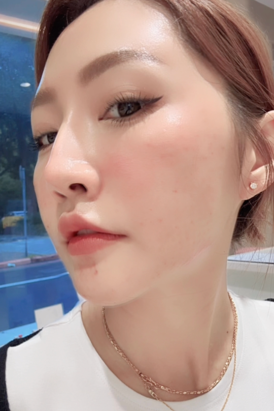 水光針到底在打什麼？它跟敷面膜差在哪？